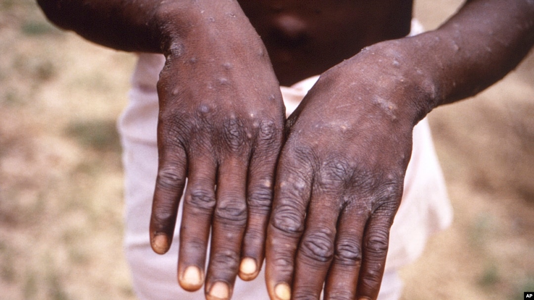 This 1997 image provided by the CDC during an investigation into an outbreak of monkeypox, which took place in the Democratic Republic of the Congo.