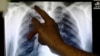 FILE - An X-ray of lungs infected with tuberculosis.