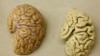 Cancer Drug May Offer Hope Against Alzheimer’s 